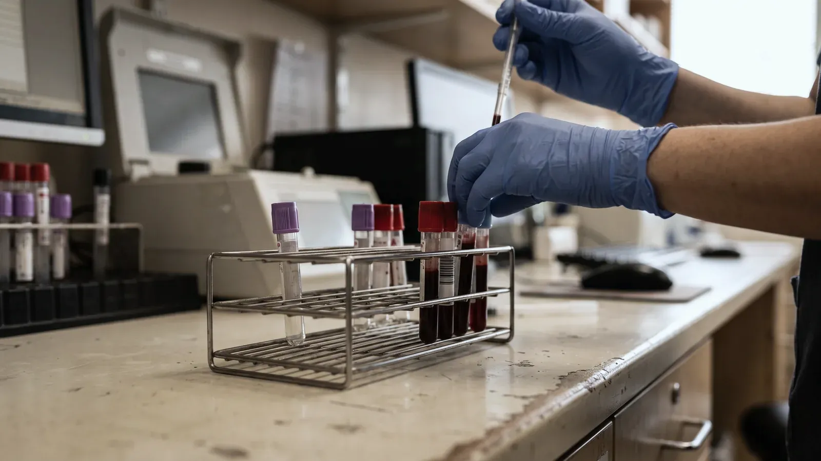 Blood samples prepared for a leukemia test for a railroad worker
